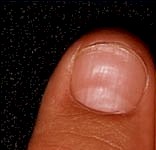 anemia. these nails show raised ridges and are thin and concave