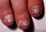 Psoriasis of the nails